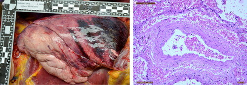 Figure 6. Blast lung injury visualized by (A) macroscopy, and (B) microscopy (HE, ×20): typical perivascular cuff-like haemorrhages.