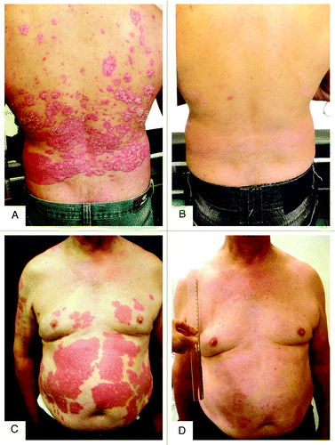 Figure 8. Photographs of two male patients with psoriasis before (A and C) and after (B and D) six months of treatment with vitamin D (35,000 IU per day). (A and B) A 59 y-old patient with BMI of 24.8 presenting a PASI score of 31 before treatment and achieving score of 18.2 after six months of treatment; his serum concentration of 25(OH)D3 was 22.8 ng/mL at baseline, reaching 127.5 ng/mL after 6 mo of treatment. (C and D) 60 y-old patient with BMI of 33.6 presenting a PASI score of 40.4 at baseline, achieving score of 12.4 after six months; his serum concentration of 25(OH)D3 was 5.6 ng/mL, reaching 103.2 ng/mL after six months of treatment.