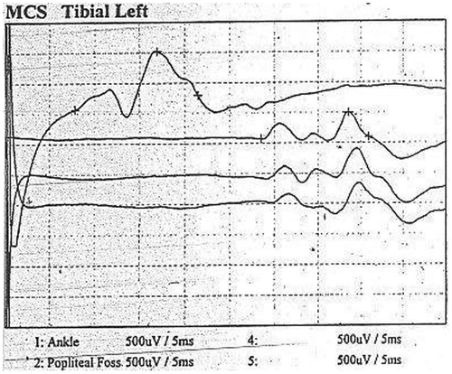 Figure 3: Nerve conduction study of the tibial nerve