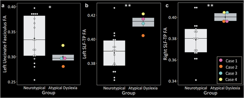 Figure 3. The four atypical presentations of dyslexia showed significantly lower fractional anisotropy (FA) in the left uncinate fasciculus (A), and significantly greater FA bilaterally in the temporoparietal superior longitudinal fasciculus (SLF-TP) (B & C). Groups were matched on age, sex, and handedness. Asterisks denote significant differences relative to neurotypical controls at *p<.05; **p<.001.
