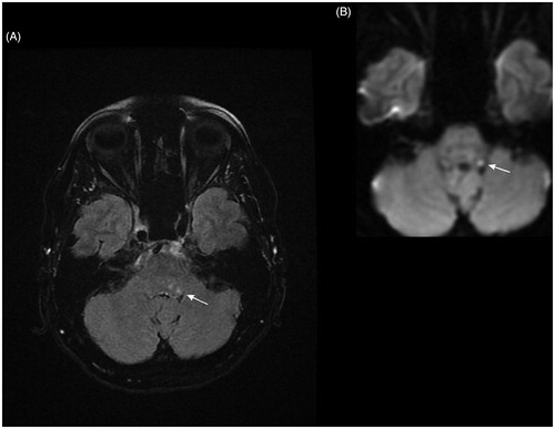 Figure 3. (A) MRI FLAIR (fluid attenuation inversion recovery) and (B) DWI (diffusion weighted imaging) axial slices show a small focus of high signal in the left facial colliculus, suggesting acute ischemia.