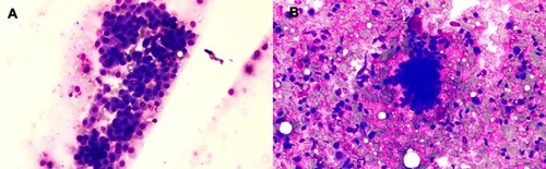 Figure 3 (A) FNAC smear showing sheet of myoepithelial cells with basophilic dense cytoplasm and central to eccentric, round to oval nuclei with bland chromatin (Giemsa stain, ×200). (B) Cluster of epithelial cells with scattered myoepithelial cells in a chondromyxoid background (Giemsa stain, ×200).