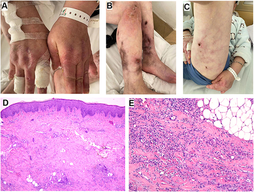 Figure 1 Pictures of hands (A), calves (B) and left thigh (C) at admission showed serious erythema, ulcers and depressed scars; H&E staining figures (D, 40× and E, 100×) of a right calf erythema showed dermal perivasculitis and subcutaneous fat inflammation.