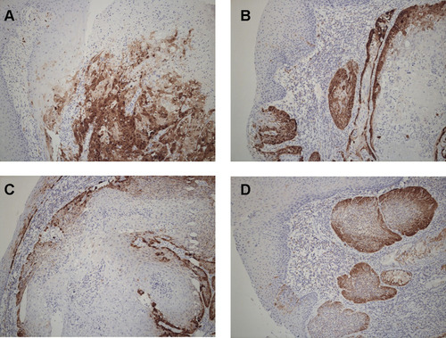 Figure 1 Expression of p16 in oropharyngeal cancer cells. Immunohistochemistry observed p16 expression in oropharyngeal cancer cells (magnification: 400). Cells with stained nuclei and cytoplasm are considered positive. Staining was scored as: (A) diffuse (> 80% of the cells were stained); (B) focal (small cell clusters, but < 80% of the cells were positive); (C) sporadic (isolated cells were positive, but < 5%); (D) negative (< 1% of the cells were positive).
