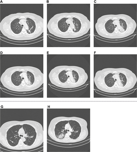 Figure 7 Radiation pneumonitis after SBRT. (A–F, see Figure 2): Consolidative changes. (A): A 78 years old female patient with histologically proven non-small cell lung carcinoma (white lines) was treated with SBRT, 5 Gy in 10 fractions, total dose 50.0 Gy. (B): Stable disease 1 month after SBRT. (C): Enlarging consolidative changes 5 months after SBRT, suspected tumour progression. Decision to wait. (D-F): The CT-changes did not change of time (D: 9 months after SBRT, (E) 12 months, (F) 18 months). Thus, radiation pneumonitis resp. radiation fibrosis was more likely than a recurrent tumour. (G and H, see Figure 1): Ground-glass opacities. (G): A 74-year-old female patient had a parathyroid carcinoma with a lung metastasis (white arrow). SBRT was performed. (H): A CT-scan 3 months after SBRT revealed radiographic radiation pneumonitis since ground-glass opacities were seen. No tumour detection at follow-up (images not shown). Thus, radiation pneumonitis was more likely than recurrence of a tumour.