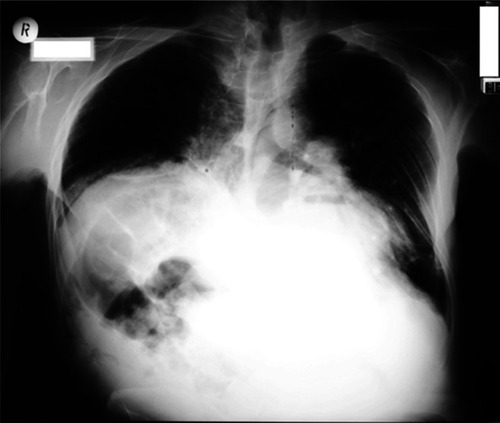 Figure 2 Chest X-ray of the patient with hypertrophic cardiomyopathy and kyphoscoliosis. Note the scoliotic curvature of the thoracic spine with the convexity on the right side and the high position of the right hemidiaphragm.