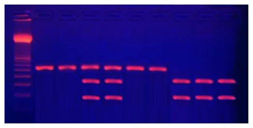 Figure 2 Electrophoresis of digested G894T polymorphism of eNOS gene poly-merase chain reaction products.