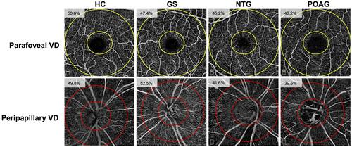 Figure 1 Optical coherence tomography angiography (OCTA) imaging of disease groups.Notes: Parafoveal and radial peripapillary capillary (RPC) vessel density measurements on en face OCTA images are shown. The parafovea is shown as the area between the two yellow circles on the angiograms centered on the fovea, while the RPC region is shown as the area between the two red circles on the angiograms centered on the optic disc. The measured vessel density is reported on each angiogram.Abbreviations: HC, healthy controls; GS, glaucoma suspects; NTG, normal-tension glaucoma; POAG, primary open angle glaucoma; VD, vessel density.