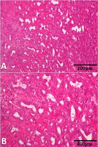 Figure 3. (A,B). Omaso-abomasal adenocarcinoma. (A) The tumor consisted of variably sized acini lined by malignant epithelial cells with moderate atypia separated by desmoplastic stroma with dense mixed inflammatory cell infiltrate (HE, ×200). (B) Extensive areas of necrosis with suppuration (HE,  ×400).