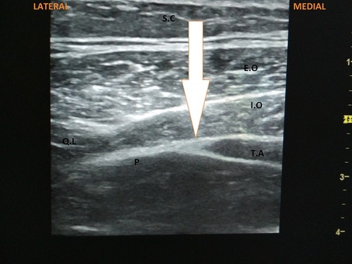Figure 9 Posterior TAP block. Arrow highlights the TAP plane where drug should be deposited.
