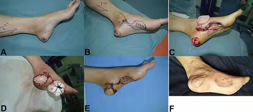 Figure 1 Excision of medial metatarsal skin mass in left heel, repair of medial plantar island flap. (A) Preoperative appearance photo, Mass size 3.0cm × 3.0cm. (B) Flap design. (C) Flap extraction, size 4.0cm × 5.0cm. (D) Flap suture. (E) Flap survival (3 weeks). (F) Followed up 44 months after operation, 2PD 5mm, no tumor recurrence, normal function.