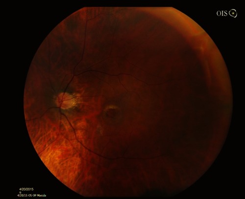Figure 1 Fundus photo showing pre-operative full thickness macular hole.