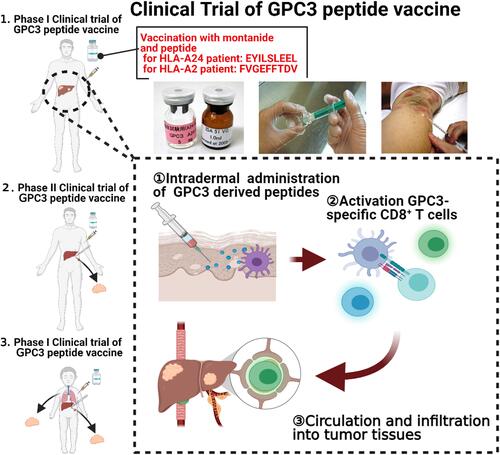 Figure 1 Scheme of our peptide vaccine trial targeting GPC3. Pictures show a series of steps to synthesize the vaccine. A24- or A2-restricted short peptides (bottle with pink label) were well mixed with montanide (bottle with white label) to prepare emulsions, and then administered to the patient intradermally. To induce a peptide-specific immune response, a series of physiological immune systems may occur in vivo (lower schemes). ① Antigen presenting cells (APCs), such as dendritic cells or Langerhans cells located in the intradermis, take up peptides of GPC3, then migrate to draining lymph nodes, where they mature. ② In draining lymph nodes, APCs present the peptides to GPC3 reactive CD8+ T cells and induce their activation and expansion. Activated CD8+ T cells differentiate into cytotoxic T lymphocytes (CTLs), infiltrate into the systemic circulation, and infiltrate into tumor tissues, resulting in tumor rejection. Using these peptide vaccines targeting GPC3, we performed phase I/II clinical trials (left figure): 1. Phase I clinical trial of GPC3 peptide vaccine in advanced HCC patients. 2. Phase II study of GPC3 peptide vaccine as an adjuvant therapy for HCC patients who underwent surgery or radiofrequency ablation. 3. Non-randomized, open-label, phase I clinical trial of GPC3 peptide vaccine in pediatric solid tumors.