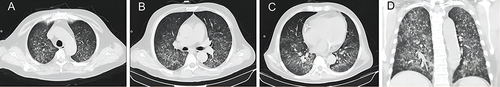 Figure 1 (A-D) Chest computed tomography revealed widespread nodular opacities and patchy areas of increased density in both lungs.