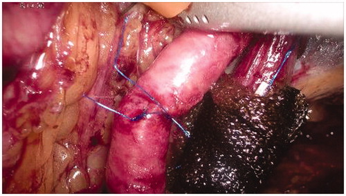 Figure 6. Completion of the vascular sutures and restoring of the normal blood flow in the external iliac vessels.