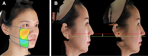 Figure 3 (A) Color map of chosen areas for volumetric measurement of the mid-cheek and jowl regions. Yellow and Orange represent relative volume gain, blue represents relative volume loss, green represents no change. (B) Comparison of height of malar prominence before and after surgery. Green dotted line represents level of pre-operative malar prominence; red dotted line represents level of post-operative malar prominence; white arrow represents height difference.