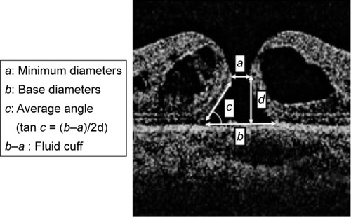 Figure 2 Minimum (a) and base (b) diameters of the macular hole, the average angle of the macular hole (c), and the fluid cuff (b–a) were measured preoperatively on OCT images.