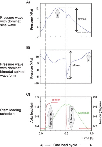 Figure 2. Typical pressure waves generated by a polished stem in a conforming cement mantle at 2 different sites, together with the stem loading schedule. The ΔPmax is the maximum pressure range developed over 1 load cycle (measured in pascals). The typical pressure wave is either dominated by a sine wave (A) or a bi-modal spiked waveform (B). The peaks of the sine wave (arrows 1 and 2) tend not to be synchronized with the peak of the applied axial load; however, the peaks in the bi-modal spiked waveform are synchronised with the torque loading.