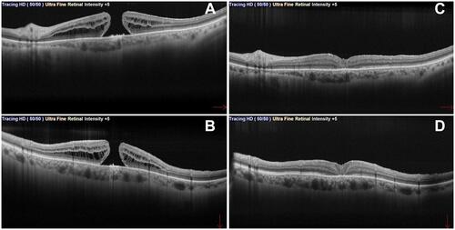 Figure 1 Full thickness macular hole (FTMH) in pre-operative (A and B) macula-cross OCT (red arrows indicates horizontal and vertical directions of the B-scan). Post-operative macula-cross (C and D) after PPV with inverted ILM flap technique.