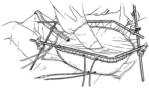 Figure 3. Line diagram of the covered technique in HIIC. Using a heavy gauge monofilament suture the skin edges are elevated on a self-retaining retractor. A small cruciate incision is made in the clear plastic to allow the surgeon's double-gloved hand to reach all portions of the peritoneal cavity and optimize the distribution of the heated chemotherapy solution. Temperature probes are placed over the skin edge. An infusion catheter and three drainage catheters are used. The inflow catheter is usually placed beneath the right hemidiaphragm and above the right lobe of the liver so that the hottest solution does not directly flow onto the small bowel. One and often two smoke evacuators are placed beneath the clear plastic sheet in order to remove any possible chemotherapy aerosols and trap them in a charcoal filtration system.