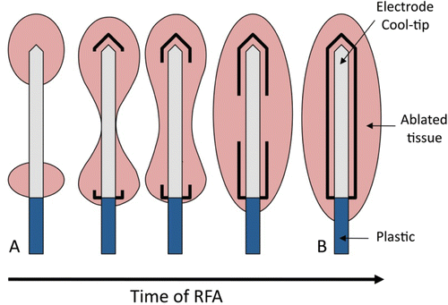 Figure 1. Schematic diagram of the progress of the coagulation zone in the tissue during radiofrequency ablation. At the beginning, the coagulated tissue is mainly located at the edges (distal and proximal), while at the end of heating the coagulated lesion has broadly extended and forms an ellipsoidal shape with the longest axis being the electrode axis. The bold lines represent the tissue heated over 100°C, i.e. strongly dehydrated zones.