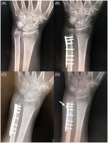 Figure 1. (A) Preoperative X-ray. (B) Postoperative X-ray (immediately after ulnar shortening osteotomy). (C) Postoperative X-ray (3 months after the surgery). (D) Postoperative X-ray (5 months after the surgery). The distal screw was loosened (Arrow). There was a bony absorption at the osteotomy site.
