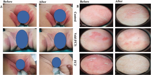 Figure 3. (A) Photographic photos of control, void, effective aspasomal cream before and after treatment in candidiasis. (B) Dermoscopic picture before treatment showed the presence of oval buds’ clusters with pseudo and true septate mycelium, and its disappearance after treatment indicates the efficacy of aspasomes encapsulated ITZ (FC2′).