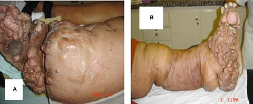 Figure 2 The leg at the start of treatment and during clinical treatment.