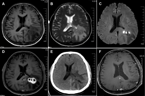Figure 1 Brain MRI and CT images pre and post surgery. (A and B) Multiloculated lesions were found with long T1-weighted and T2-weighted images in the left temporo-occipital lobe. The lesions were surrounded by large patches of edema. (C) Diffusion-weighted imaging showed high signal intensity in the center of the lesions. (D) Gadolinium-enhanced T1-weighted image demonstrated ring-enhancing lesions. (E) A CT scan one week after surgery. (F) There was no residual enhancing lesion at 4 months after surgery.