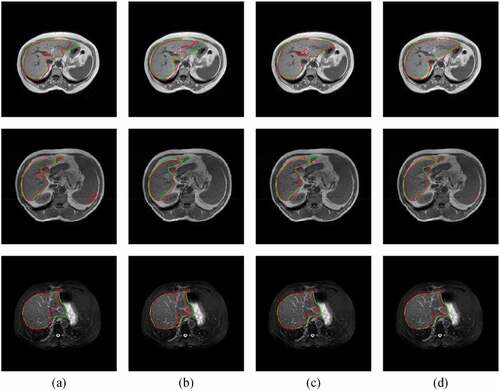 Figure 8. Typical liver segmentation results on MR images with the T1-DUALin (top row), the T1-DUALout (middle row), and the T2-SPIR (bottom row) sequences by using four methods. (a) 3D U-Net. (b) 3D Auto-Net. (c) 3D UNet++. (d) the proposed method. Green contours indicate the ground truth segmentation, and red contours indicate the automatic segmentation by the algorithm.