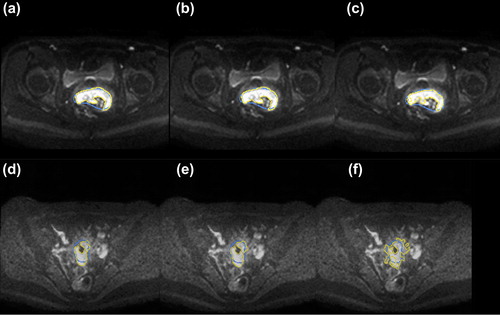 Figure 3. DW-MR images at b = 1000 s/mm2 at treatment time PRERT (a, b, c) and PREBT (d, e, f) for the three different segmentation methods: a, d: clustering, b, e: SD4 and c, f: region-growing. The yellow contour illustrates the segmented volume while the blue contour is the GTV as delineated on T2W images.