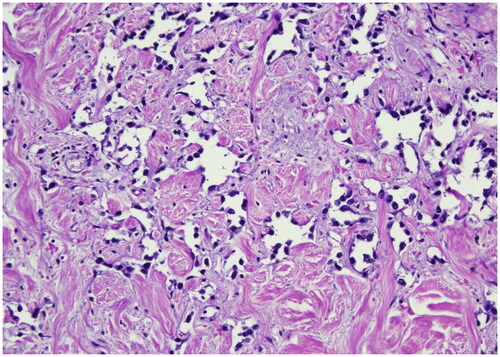 Figure 3. H&E stain (40x), histological findings tipically shows dermal basal proliferation of irregular staghorn branched blood vessel with atypical epithelioid cells with large pleomorphic vescicular eosinophilic nuclei and small micro papillary proliferations.