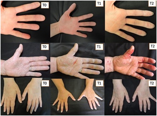 Figure 4. Three patients of control group. Worsening of HE during the two months of treatment.