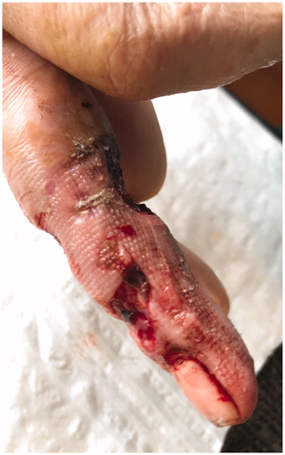 Figure 10. Skin after sucessive surgical debridements and sterile dressings (7 weeks).