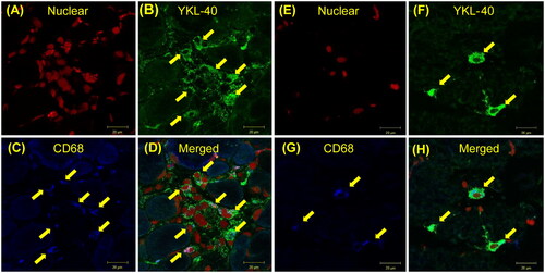 Figure 4. Fluorescence staining of muscle biopsy from patients with PM/DM. Fluorescence staining of PM/DM muscle biopsies (PM, n = 2; DM, n = 2). (A–D) PM; (E)–(H) DM. (A, E) nuclei in red; (B, F) YKL-40 in green; (C, G) CD-68 in blue; (D, H) merged cells in light blue. The yellow arrows indicate the macrophages. The cells containing CD-68 and YKL-40 and the merged cells are all the same cells. Magnification is ×630. Bar, 20 μm. DM: dermatomyositis; PM: polymyositis.