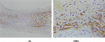 Figure 8 Regenerated nerve fibers grow through the conduit (2nd week, S100 immunohistochemistry staining).