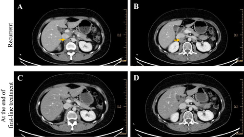Figure 3 Lymph nodes recurrent between the aorta and inferior caval vein. (A and B) Contrast-enhanced CT scan shows enlarged lymph nodes between the aorta and inferior caval vein (arrow indicated); (C and D) CT showed negative findings at the end of first-line treatment.