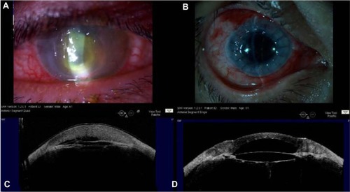 Figure 2 A 61 year-old male patient, who had a complicated cataract surgery elsewhere 3 months ago, presented with severe visual loss and pain; the visual acuity was 20/2000.
