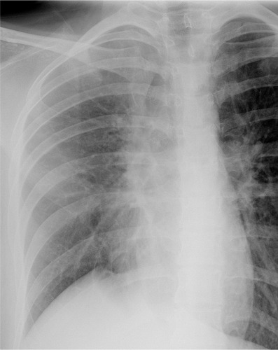 Figure 7 Follow-up frontal chest radiograph.