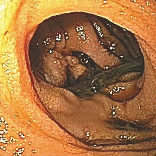 Figure 1. Upper endoscopy showing superficial gastric erosions and a small clot at the choledochojejunal anastomosis without active bleeding