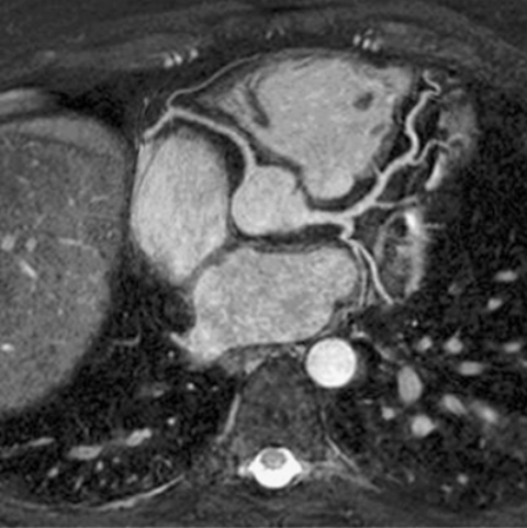 Figure 2. WH‐MRA of LCA in a healthy subject.