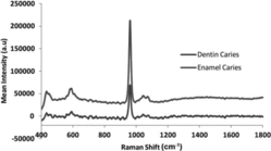 Figure 5 Raman spectra of caries in enamel and dentin. Courtesy of de Carvalho et al. (Citation32).