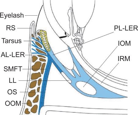 Figure 3 A diagram of epiblepharon. The eyelash is always directed upright, irrespective of skin redundancy.