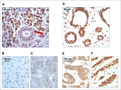 Figure 1. Patterns of LC3B and HMGB1 immunohistochemical staining of breast adenocarcinomas in the training cohort. (A) LC3B puncta in a breast adenocarcinoma: nonmalignant breast gland (red arrow) staining negatively for LC3B, in the proximity of tumor cells with intense LC3B positivity. (B) Representative aspect of a breast adenocarcinoma without any detectable cytoplasmic LC3B puncta. (C) Cytoplasmic LC3B puncta in a breast adenocarcinoma that was considered as positive for LC3B staining. (D) Representative strong nuclear HMGB1 staining in normal mammary glands. (E) Representative aspect of a breast adenocarcinoma without any detectable nuclear staining (tumor considered as negative for nuclear HMGB1 expression). (F) Homogeneous nuclear HMGB1 staining in a breast adenocarcinoma considered as positive for HMGB1 nuclear expression.