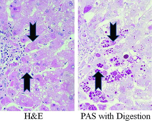 Figure 1.  Photomicrograph of human Pi*ZZ liver. Human Pi*ZZ liver stained with H&E (left panel) and Periodic Acid-Schiff with digestion (PAS with digestion, right panel) showing inclusions (“globules”) of AAT mutant Z polymerized protein visible within some hepatocytes (arrows).