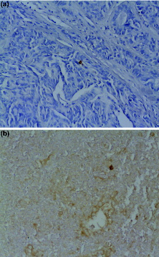 Figure 3. Blood vessel density in different types of thyroid cancers.Note: PTC, papillary thyroid cancer; FTC, follicular thyroid cancer; ATC, anaplastic thyroid cancer; OTC, oncocytic thyroid cancer. Data are presented as mean ± SD (*p = 0.039).