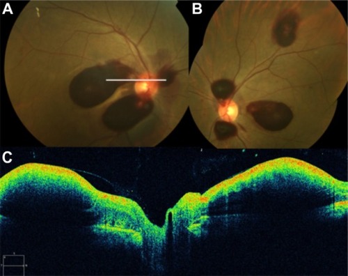 Figure 59 (A and B) Fundus color photographs of both eyes show scattered preretinal hemorrhages at the macula and surrounding the optic disk, secondary to medullary aplasia. (C) The Cirrus™ OCT image shows increased thickness and reflectivity due to the presence of blood over the inner retinal layers, causing shadowing of the optical signals of the outer retinal layers and the retinal pigment epithelium/choriocapillaris complex.