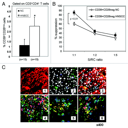 Figure 2.Frequency and activity of CD4+CD39+CD26neg in NC and HNSCC patients. (A) Freshly isolated PBMC from NC (n = 15) and HNSCC patients (n = 15) were stained and analyzed by flow cytometry. The data are means ± SD. The asterisk indicates p < 0.01. (B) PBMC obtained from NC or HNSCC patients were single-cell sorted into CD4+CD39+CD26neg and CD4+CD39neg responder T cells (RC). The latter were CFSE labeled and stimulated with plate-bound OKT-3 and soluble anti-CD28. Following addition of CD4+CD39+CD26neg suppressor cells and 150 IU/mL of IL-2, the co-cultures were incubated for 5 d. Cells were analyzed by flow cytometry as described in Materials and Methods. Suppression of RC cell proliferation mediated by CD4+CD39+CD26neg obtained from NC or cancer patients at various S/RC ratios is shown. Data represent means ± SD from three independent experiments. (C) Tumor-infiltrating T cells are shown in sections of a representative HNSCC of five specimens examined (mag. x 400) (1) tumor cells (red, stained with pancytokeratin) (2) few green CD26+ T cells are among tumor cells; tumor cell nuclei are white (DAPI); no ADA+ cells stained blue are visible. (3) Sections 1 and 2 in a merged image. Tumor cells are negative for ADA and CD26. (4) A lymphoid infiltrate into tumor is stained for CD4 (green), ADA (red) and CD26 (blue). A co-localization of ADA and CD26 in CD4+ cells (pink) is evident. (5) A tumor section containing infiltrating lymphoid cells is stained for CD4 (green), ADA (red) and FOXP3 (blue). CD4+FOXP3+ Treg (green/blue) are negative for ADA, whereas CD4+FOXP3neg Teff cells (yellow/red) are positive for ADA. (6) A lymphoid infiltrate into tumor is stained for CD4 (green), ADA (blue) and CD132 (red). CD4+CD132+ Tr1 are negative for ADA (yellow/red), whereas CD4+CD132neg Teff cells are mostly positive for ADA (blue).