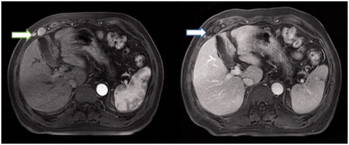 Figure 2. Sixty-four year old male with abdominal wall implants from hepatocellular carcinoma (HCC). (A) Two nodules were found in the right abdominal wall in the arterial phase in the axial enhanced MRI (arrow) before US-guided MWA, and one was measured in 3.3 × 3.2 × 2.1 cm, another one was in 1.3 × 1 × 0.8 cm. (B) Two nodules were treated after 1 month undergoing US-guided MWA. The thermal ablation field was found in the right abdominal wall in the delay phase in the axial enhanced MRI (arrow).
