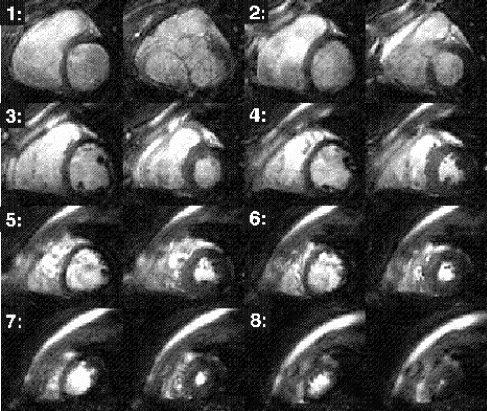 Figure 2. Synchronized real-time movie loops of 8 slices were acquired in an 8-second breath hold. (left) end-diastolic and (right) end-systolic frames are shown. In addition to wall motion assessment, the following data were quantified: EDV=108.5 ml, ESV=42.0 ml, EF=61.3%, Mass=129.7 g.